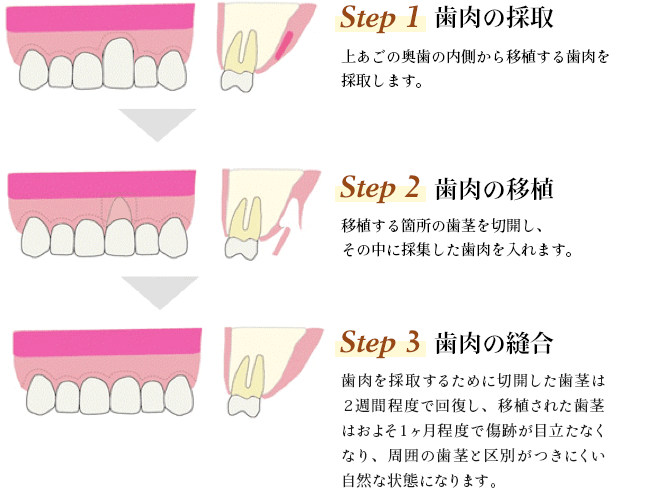 上あごの奥歯の内側から移植する歯肉を採取します。 移植する箇所の歯茎を切開し、その中に採集した歯肉を入れます。 歯肉を採取するために切開した歯茎は２週間程度で回復し、移植された歯茎はおよそ1ヶ月程度で傷跡が目立たなくなり、周囲の歯茎と区別がつきにくい自然な状態になります。